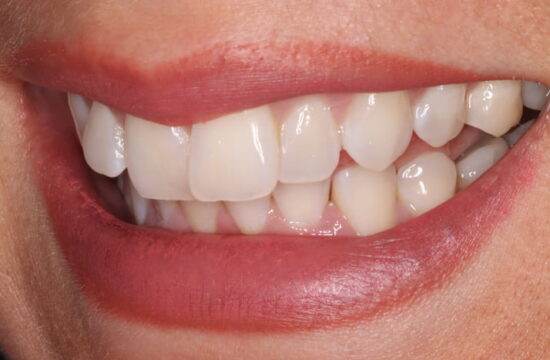 Before -Optima Dental Care
