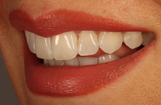 After -Optima Dental Care