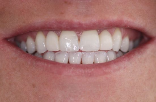 After -Optima Dental Care