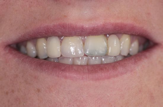Before -Optima Dental Care