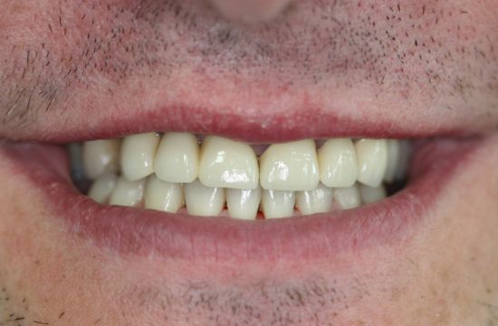 After -Optima Dental Care