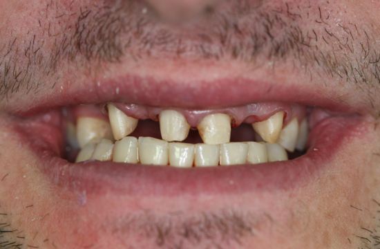 Before -Optima Dental Care