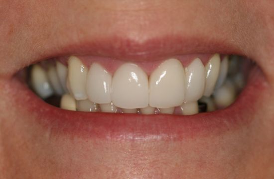 After -Optima Dental Care