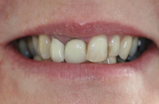 Before -Optima Dental Care