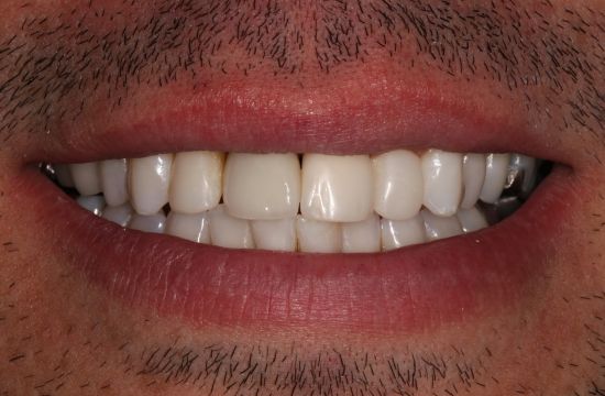 After -Optima Dental Care