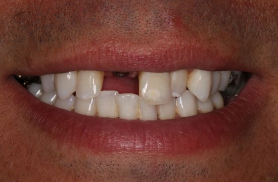 Before -Optima Dental Care
