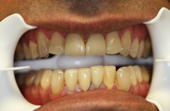 Before -Optima Dental Care
