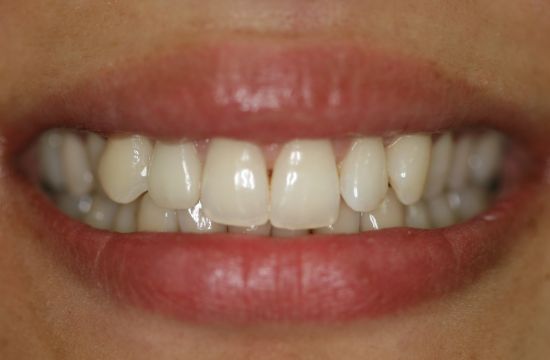 After -Optima Dental Care