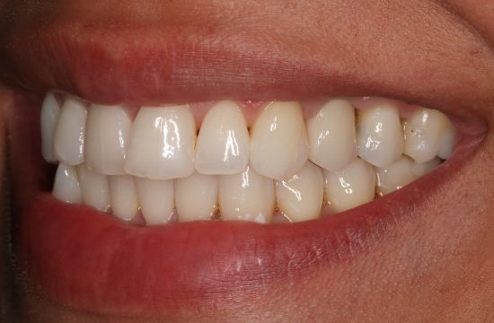 After -Optima Dental Care