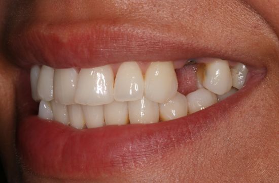 Before -Optima Dental Care