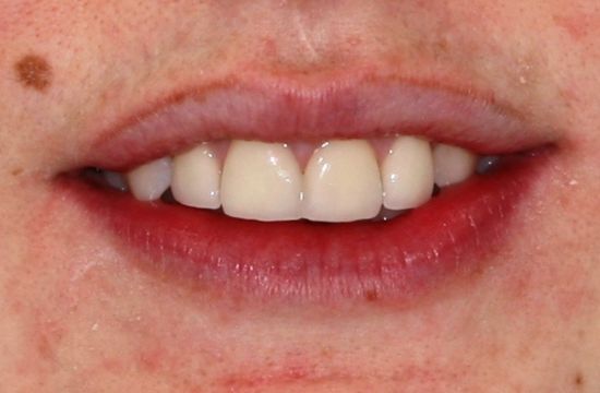 After -Optima Dental Care