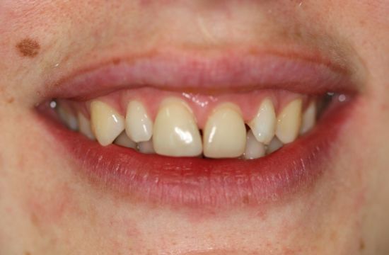 Before -Optima Dental Care
