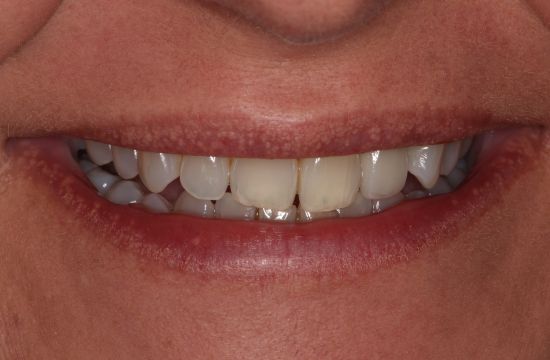 After -Optima Dental Care