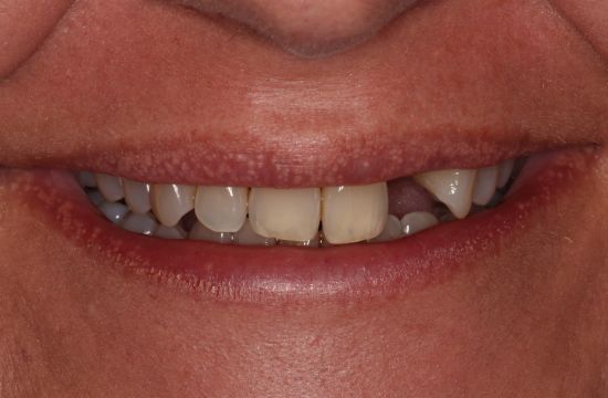 Before -Optima Dental Care