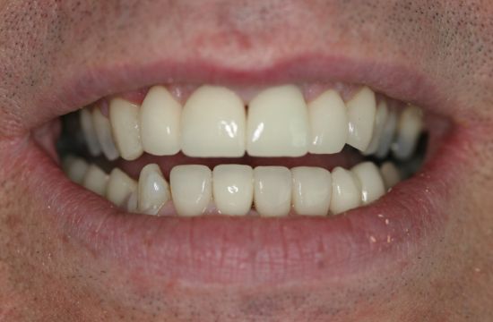 After -Optima Dental Care