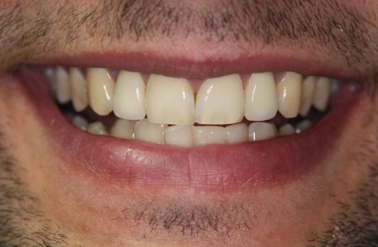 After -Optima Dental Care