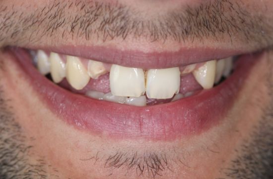 Before -Optima Dental Care