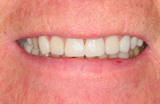 After -Optima Dental Care