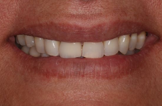 After -Optima Dental Care