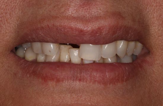 Before -Optima Dental Care