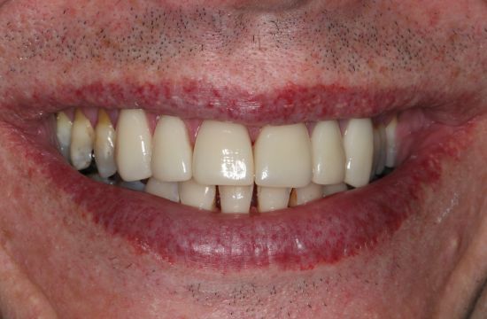 After -Optima Dental Care