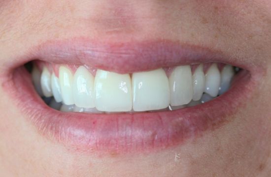 After -Optima Dental Care