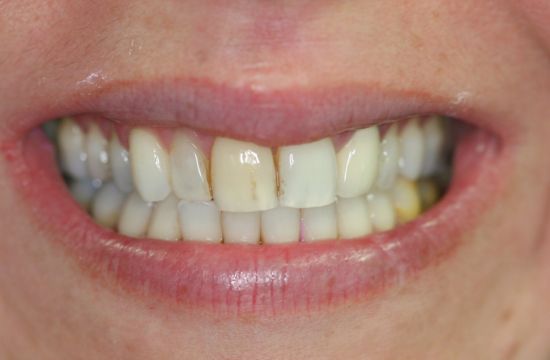 Before -Optima Dental Care