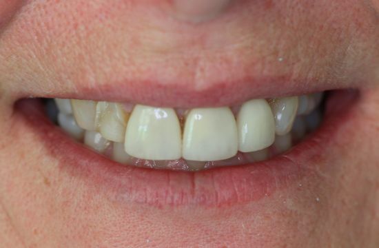 Before -Optima Dental Care