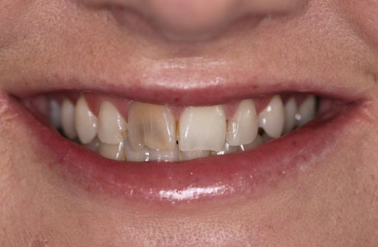 Before -Optima Dental Care