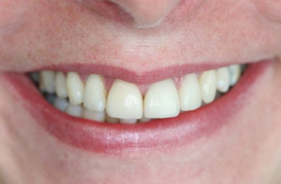 After -Optima Dental Care