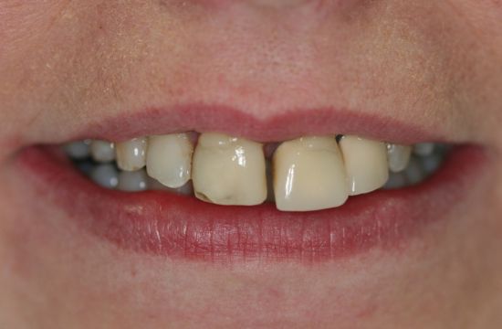 Before -Optima Dental Care