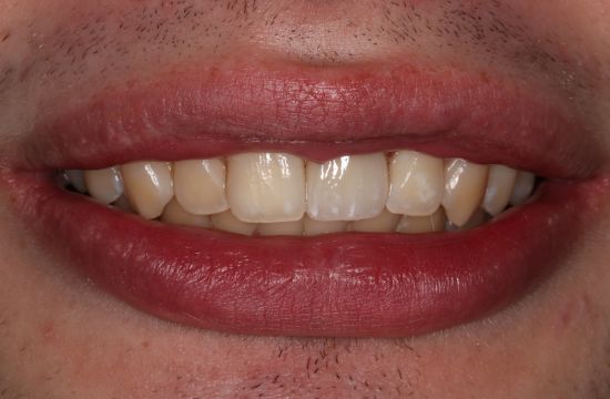 After -Optima Dental Care