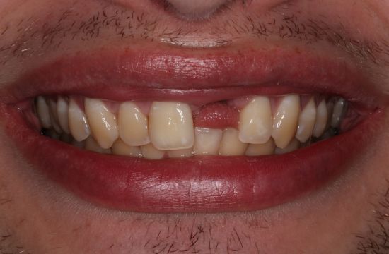 Before -Optima Dental Care