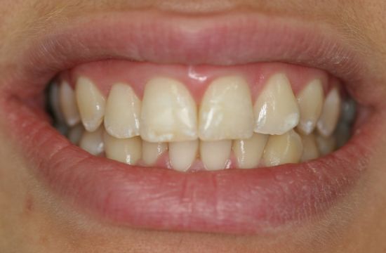 Before -Optima Dental Care