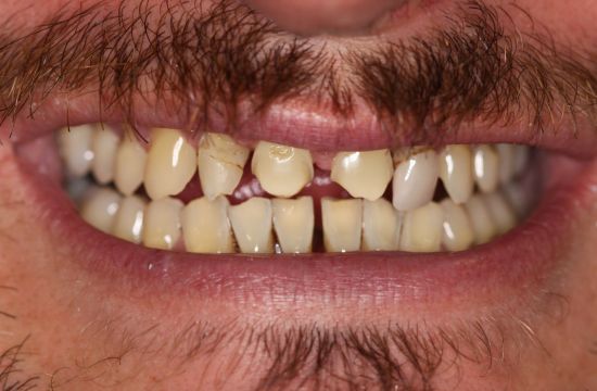 Before -Optima Dental Care