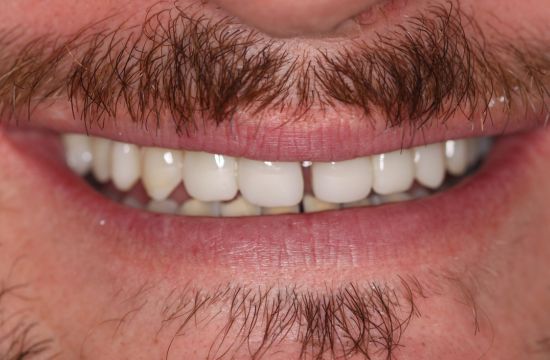 After -Optima Dental Care