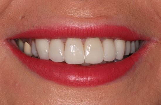 After -Optima Dental Care