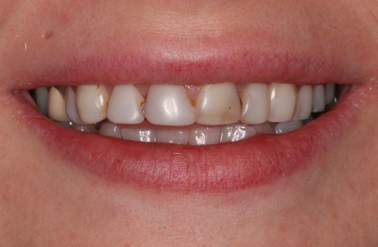 Before -Optima Dental Care