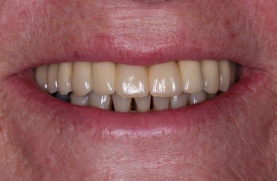 After -Optima Dental Care