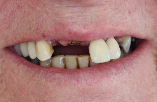 Before -Optima Dental Care