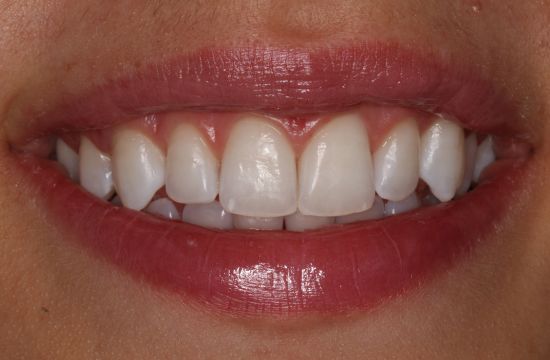 After -Optima Dental Care