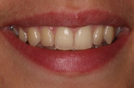 Before -Optima Dental Care