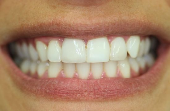 After -Optima Dental Care