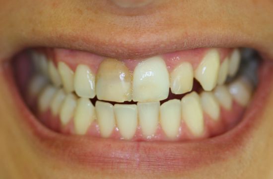 Before -Optima Dental Care
