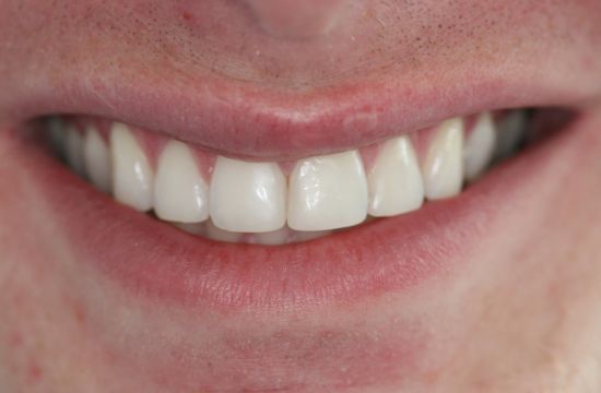 After -Optima Dental Care