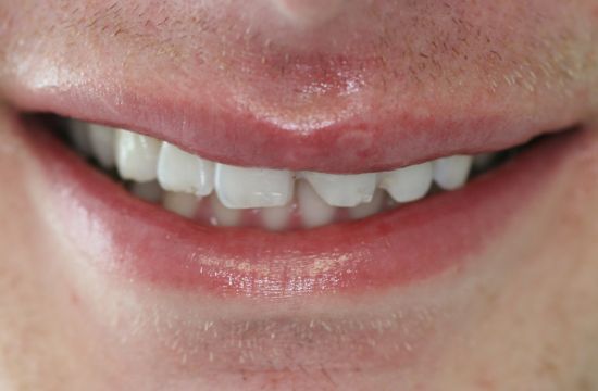 Before -Optima Dental Care