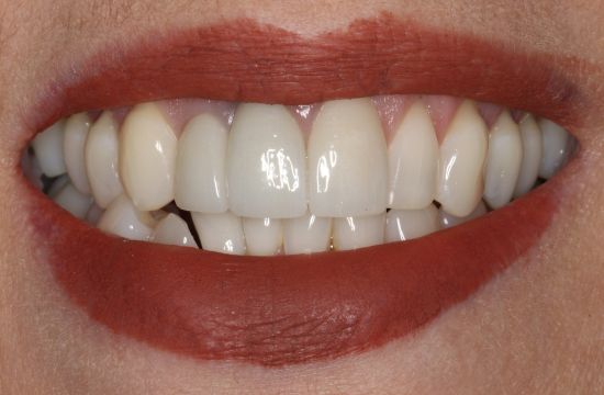 After -Optima Dental Care