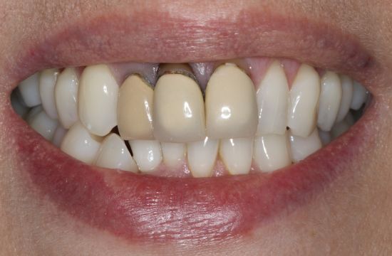 Before -Optima Dental Care