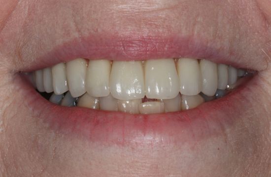 After -Optima Dental Care