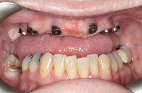 Before -Optima Dental Care